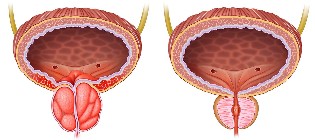 Prostate enflammée et saine après avoir utilisé des capsules pré-stonorm