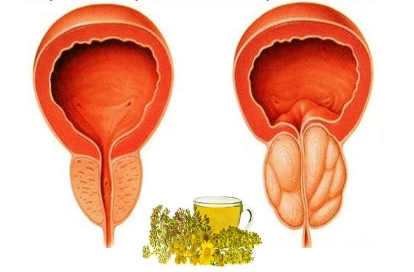 Prostate sain et mal